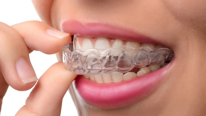A clear aligner being fitted over the teeth