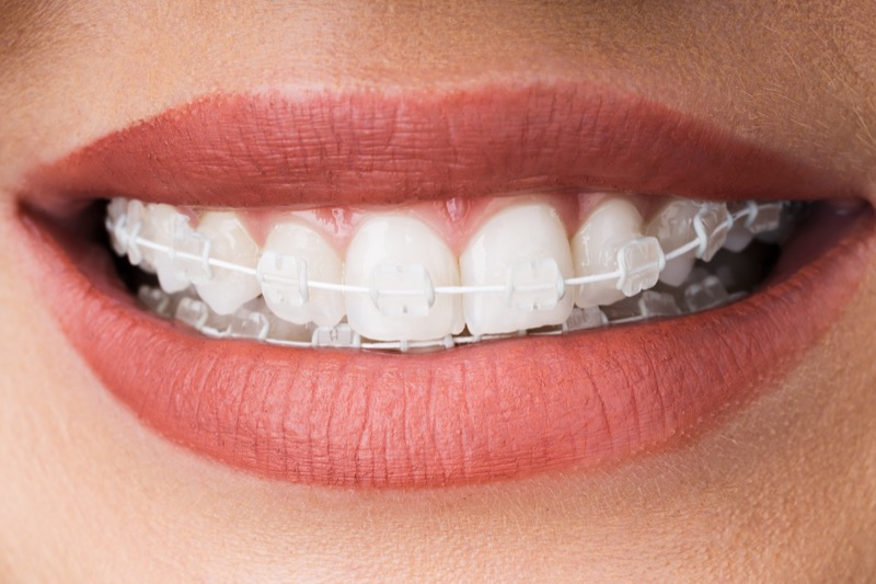 Smile with fixed braces made of tooth-coloured ceramic brackets