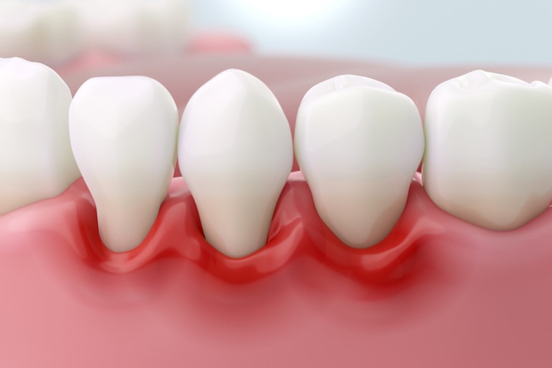 Illustration of red, inflamed gums affected by periodontitis