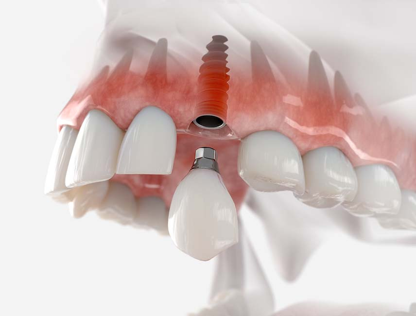 Illustration of a dental implant with abutment and crown in the upper jaw